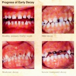 Baby Tooth Decay