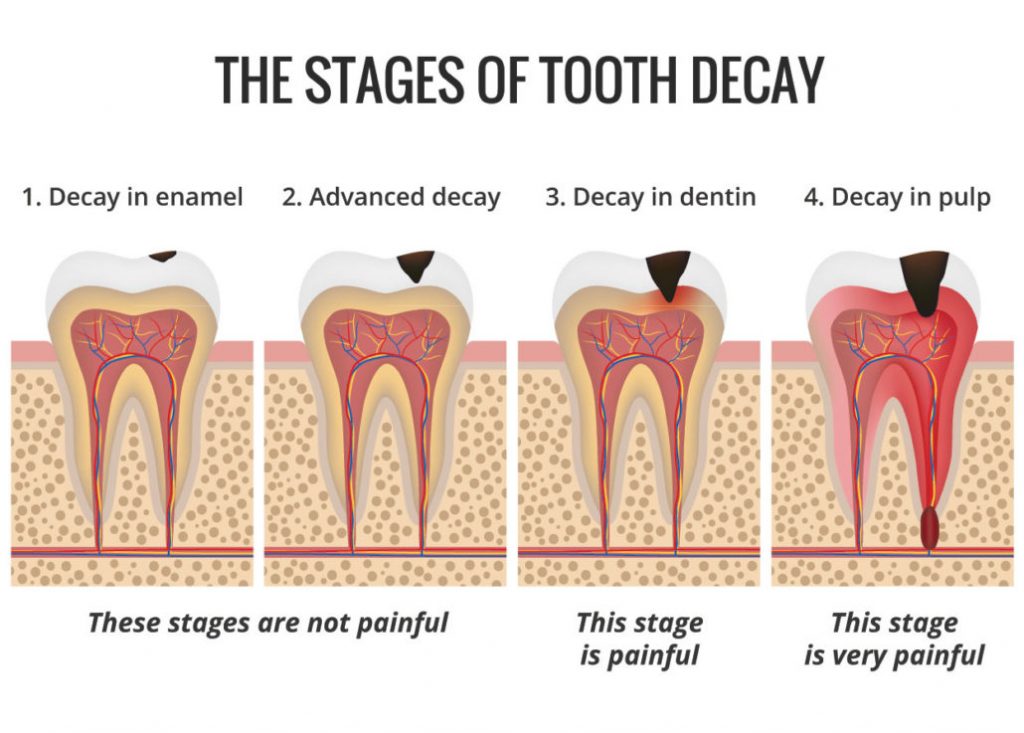 Tooth decay stages