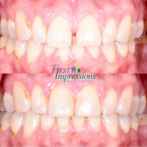 invisalign why
